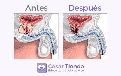 Tratamiento fisioterápico pre y post quirúrgico en las intervenciones de próstata